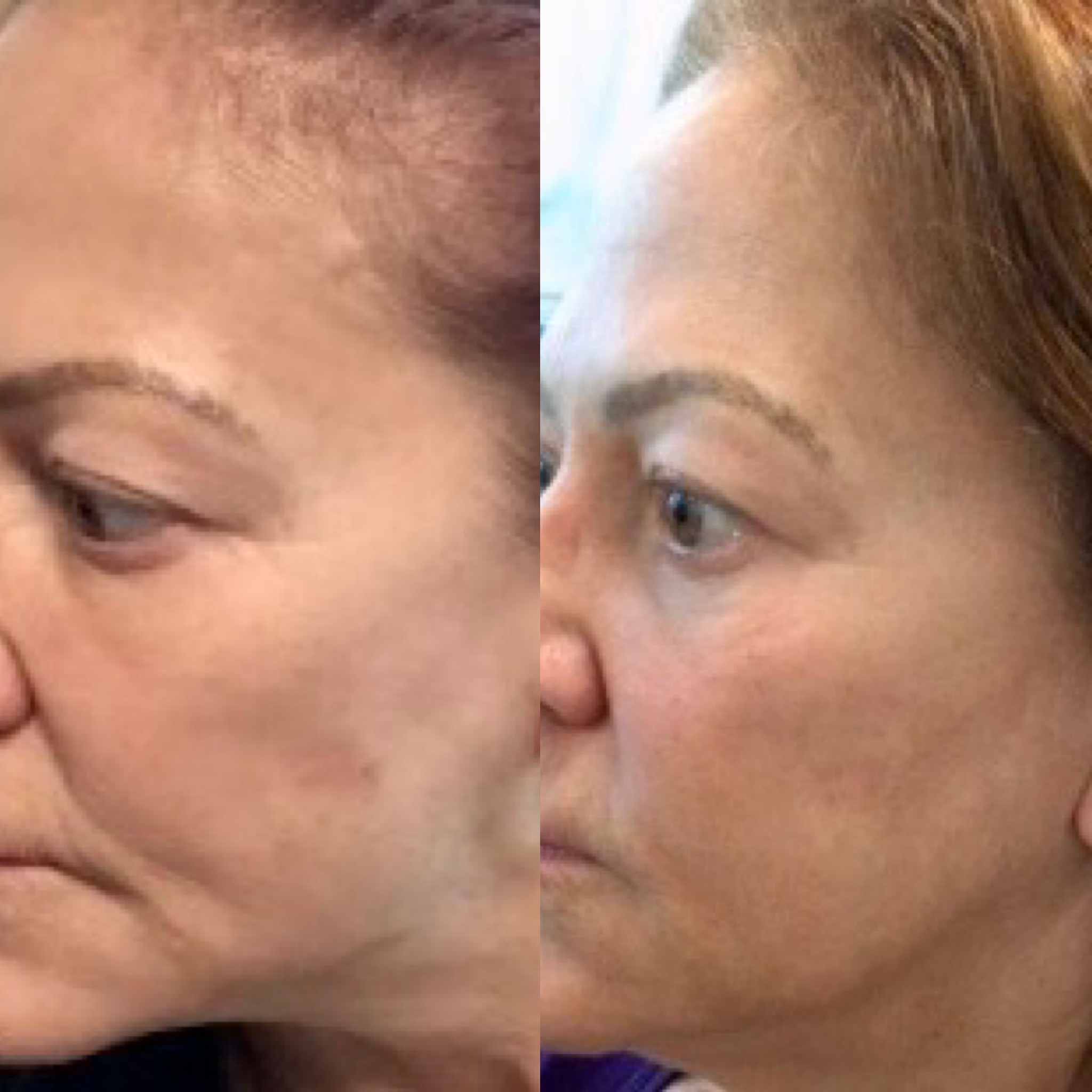 Additional before and after exosome microneedling results