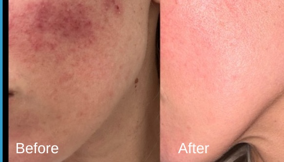 Before and after exosome microneedling results